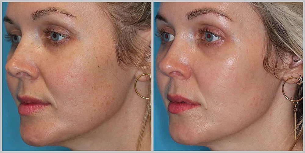 Before and after facial treatment comparison.