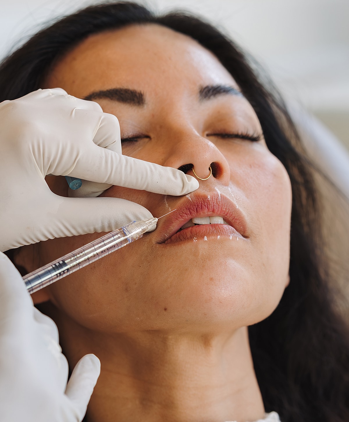 Lip filler procedure in progress on patient.