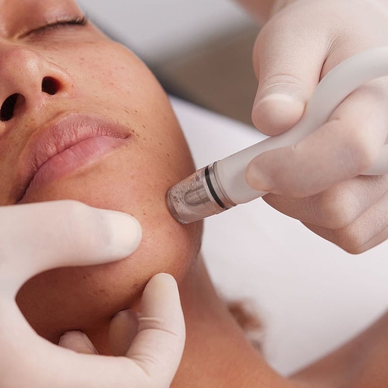 Facial treatment using a microneedling device.