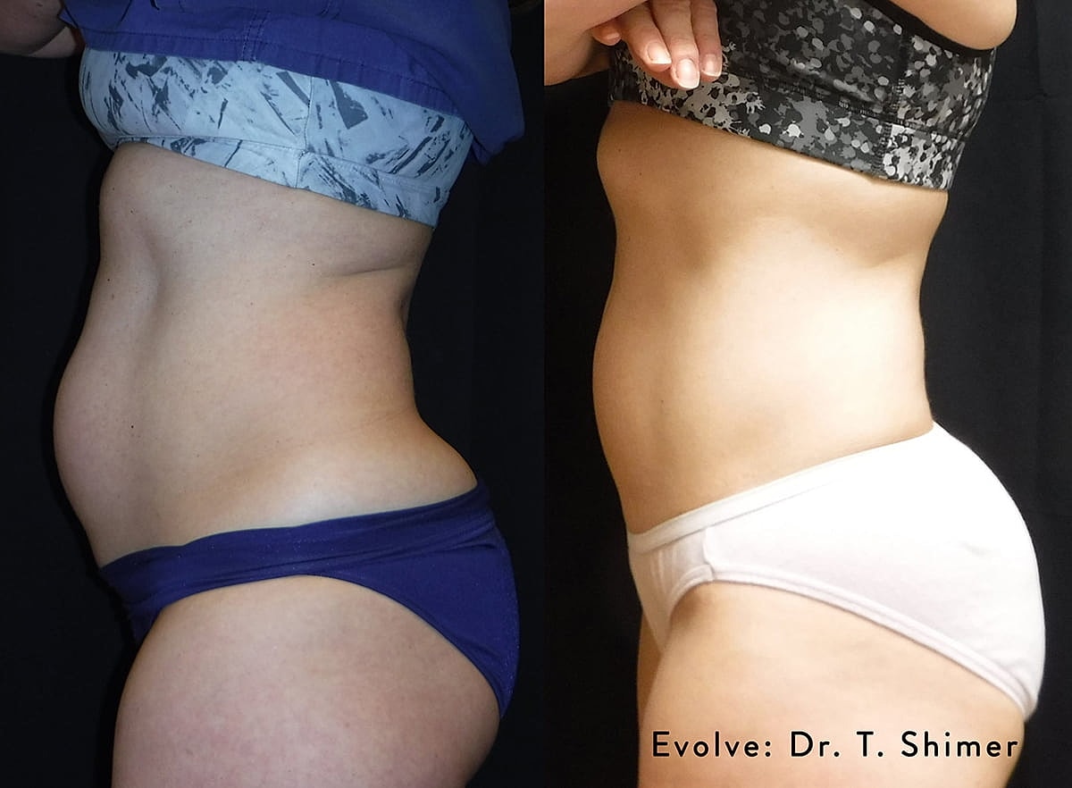 Before and after body transformation comparison.