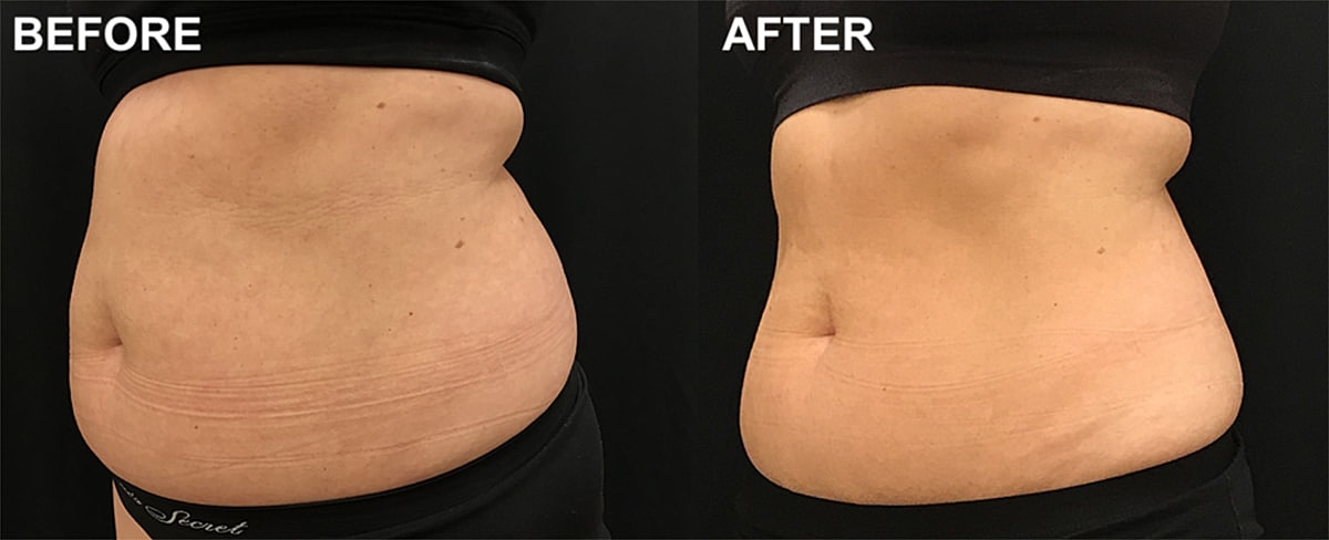 Before and after body transformation comparison.