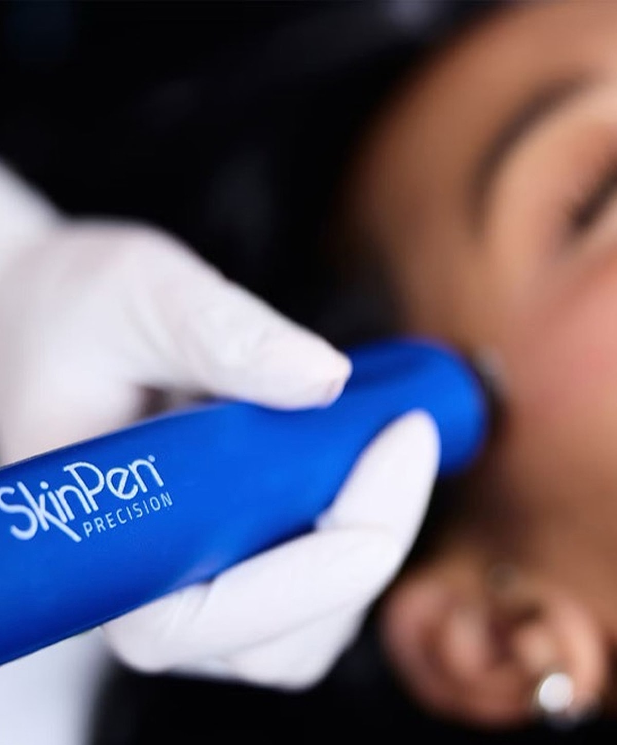 SkinPen precision device in use on skin.