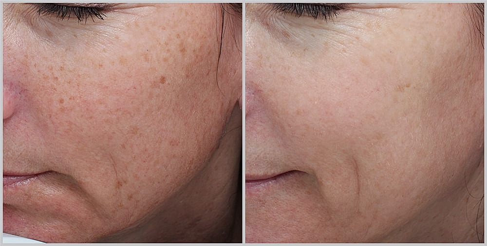 Before and after skin treatment results comparison.