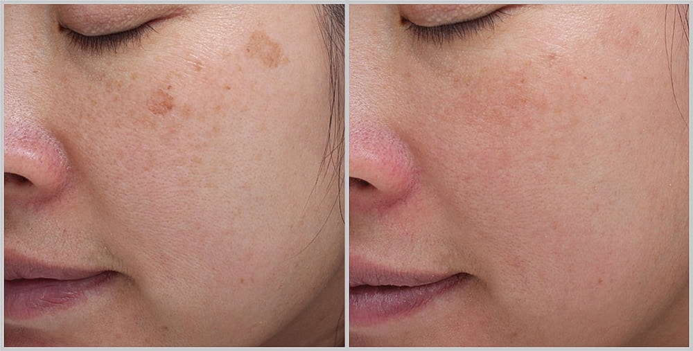 Before and after skin treatment results.