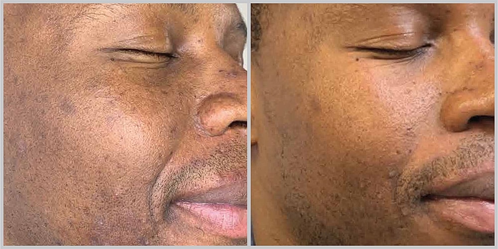 Before and after skin treatment comparison.