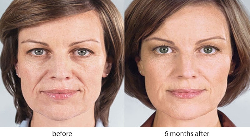 Comparison of facial appearance before and after treatment.