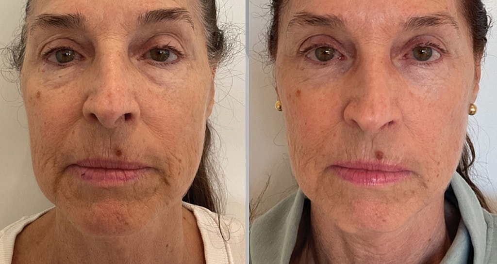 Before and after facial treatment comparison.