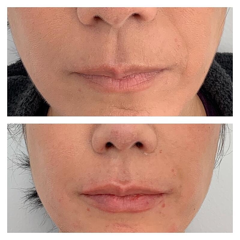 Lip Filler Before & After