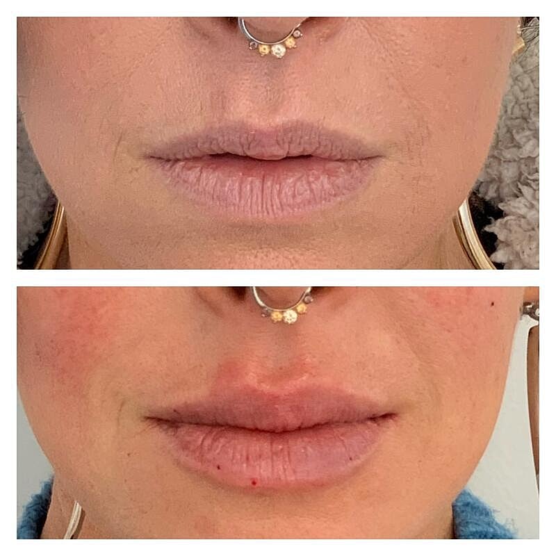 Lip Filler Before & After