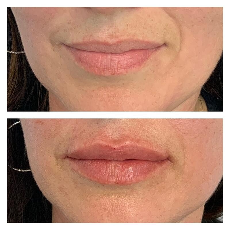 Lip Filler Before & After