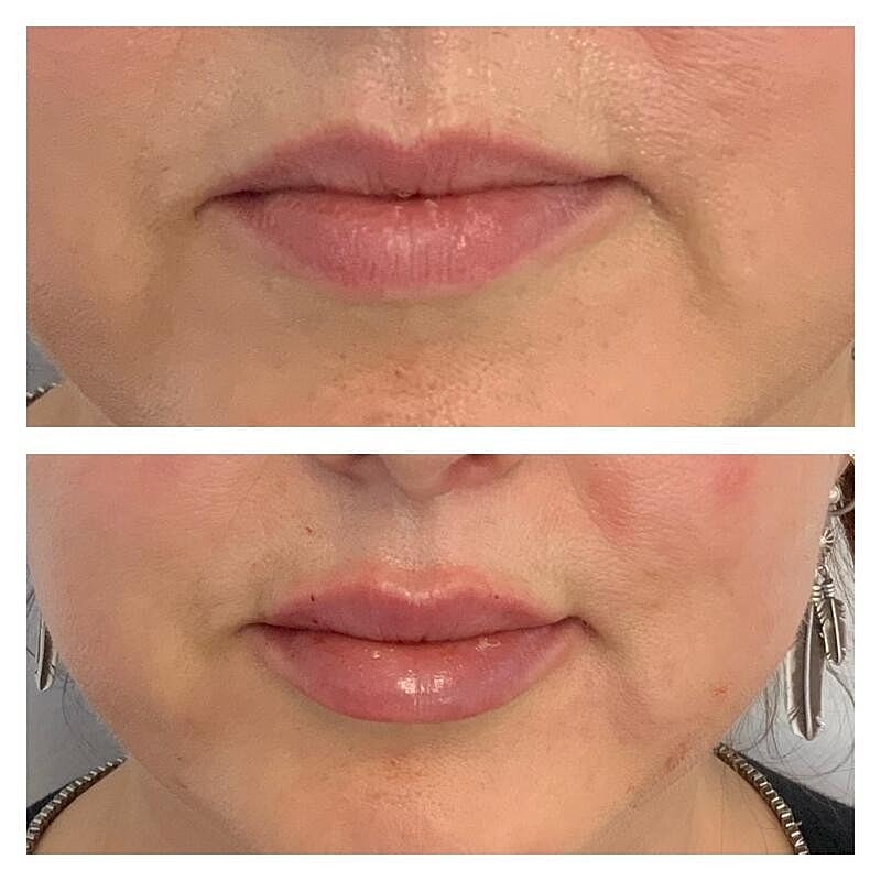 Lip Filler Before & After