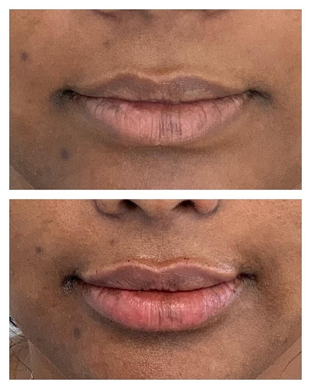 Lip Filler Before & After