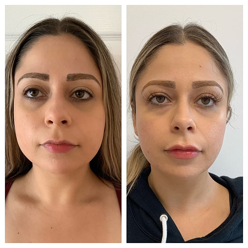 Lip Filler Before & After