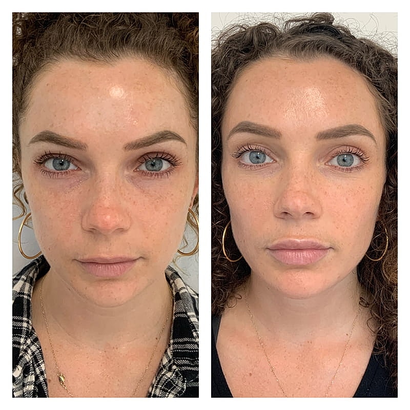 Lip Filler Before & After