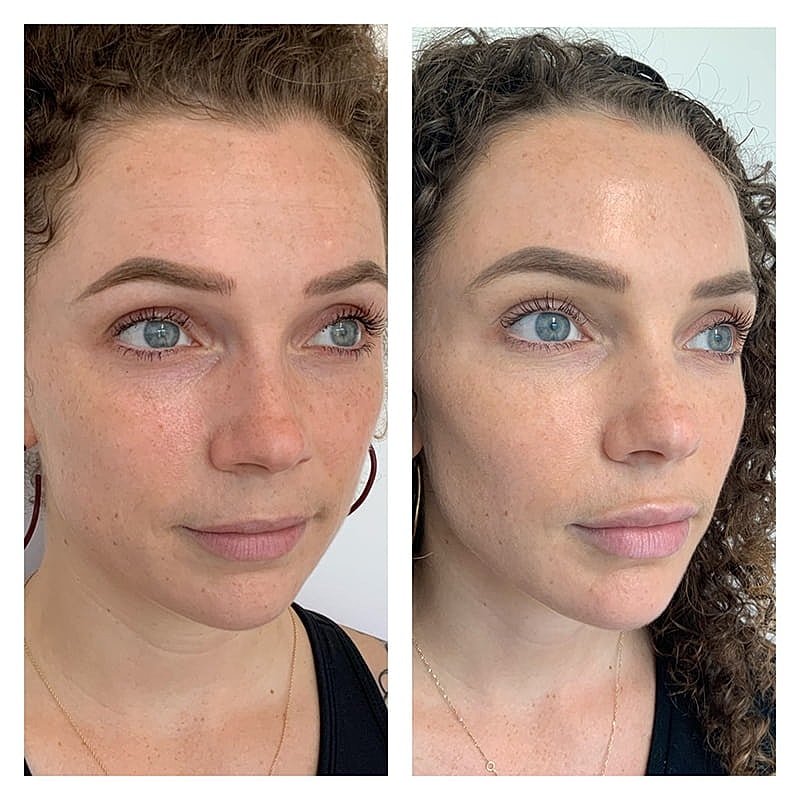 Lip Filler Before & After