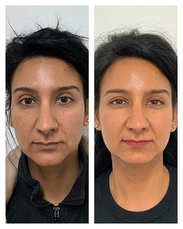 Prp Microneedling Before & After