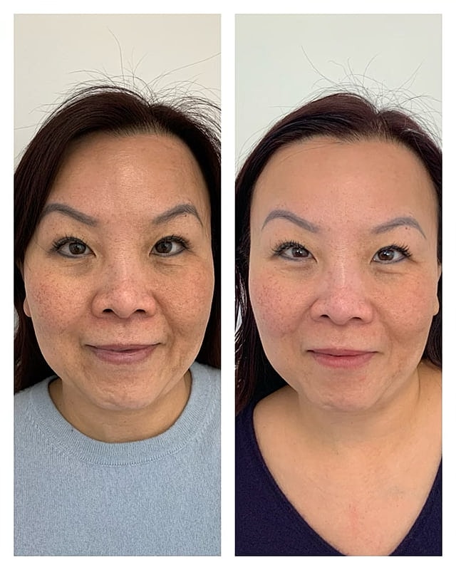 Prp Microneedling Before & After