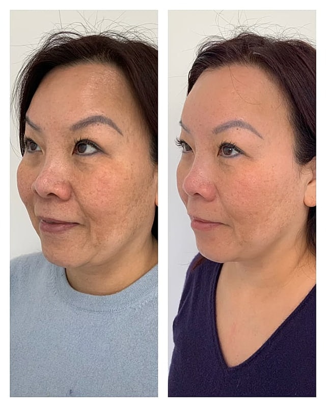 Prp Microneedling Before & After