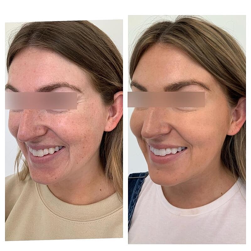 Botox Before & After