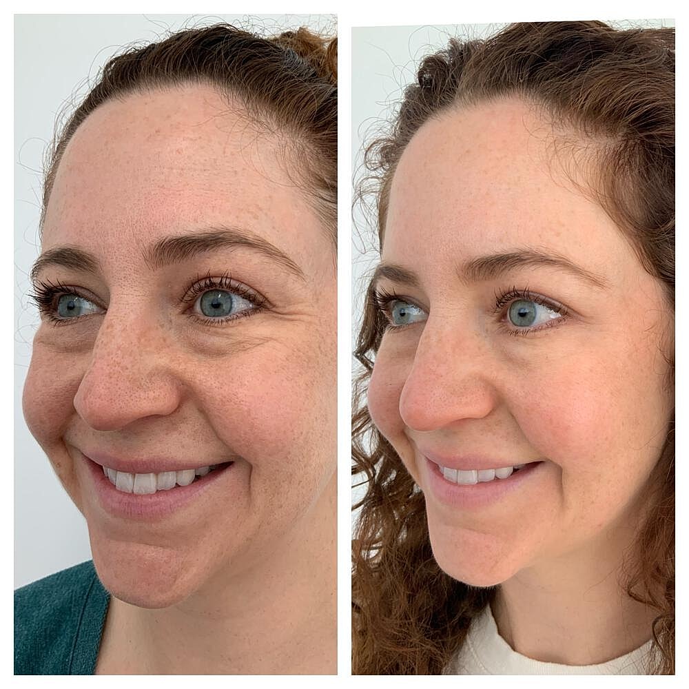 Botox Before & After