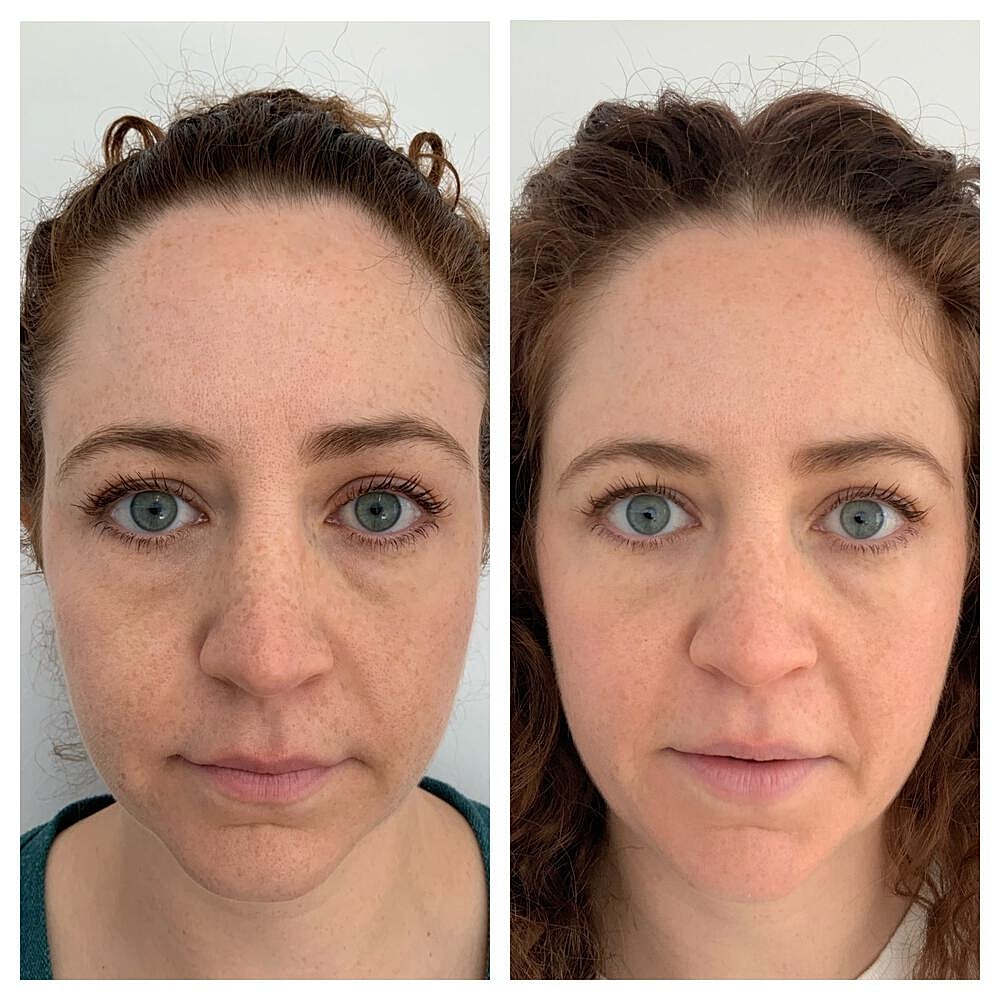Botox Before & After