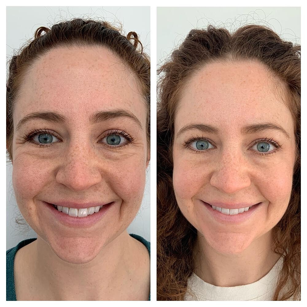 Botox Before & After