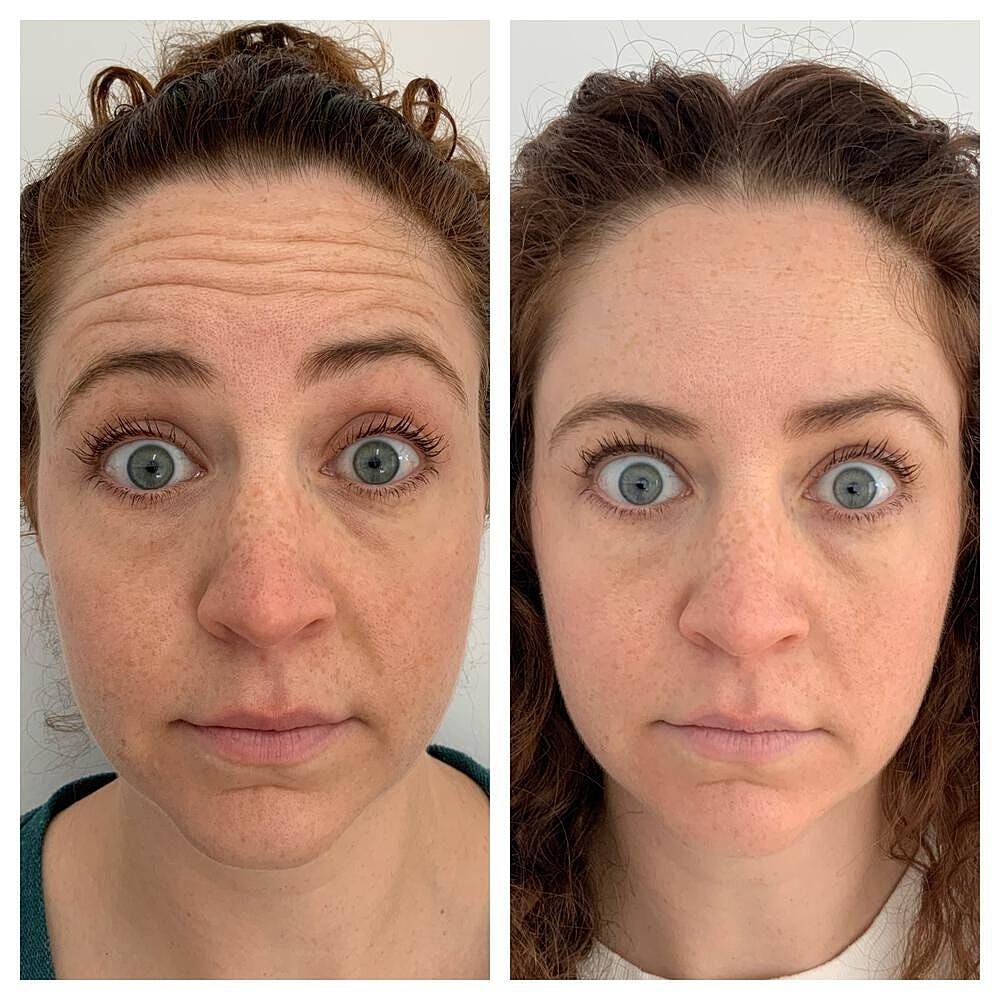Botox Before & After