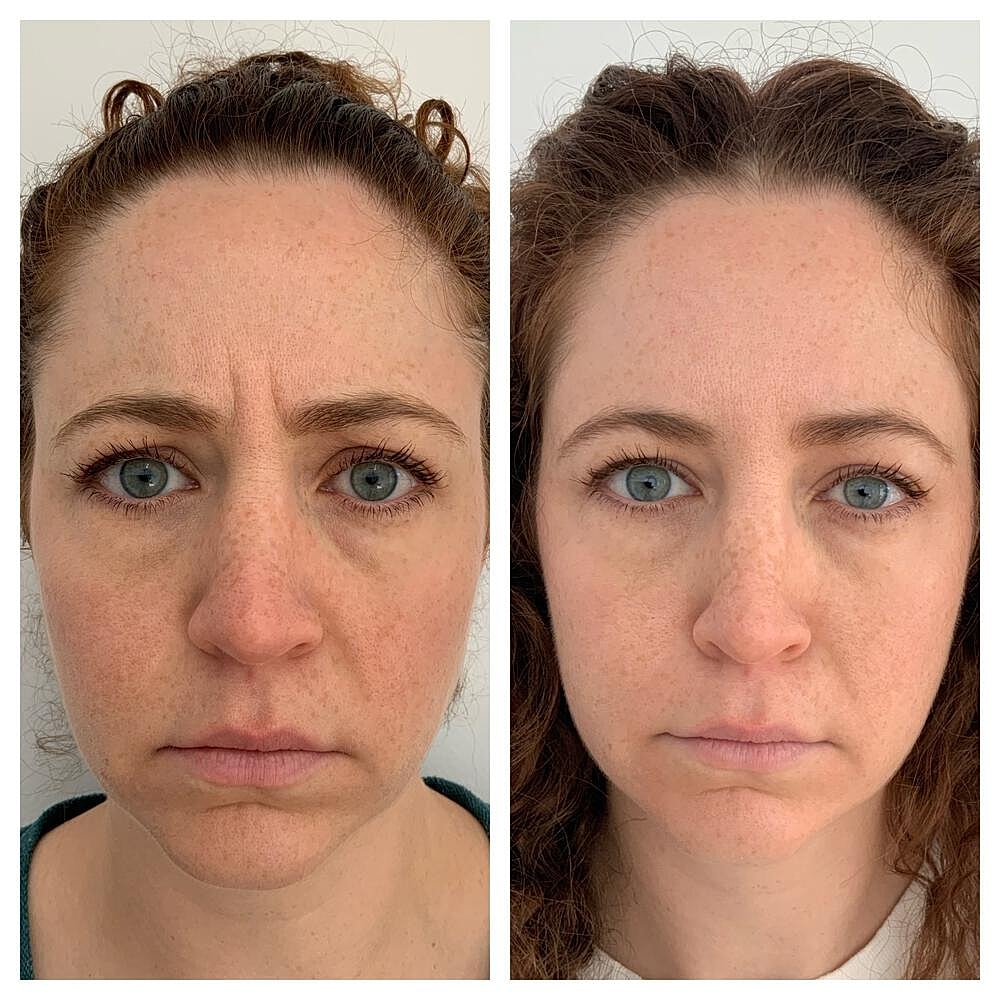Botox Before & After