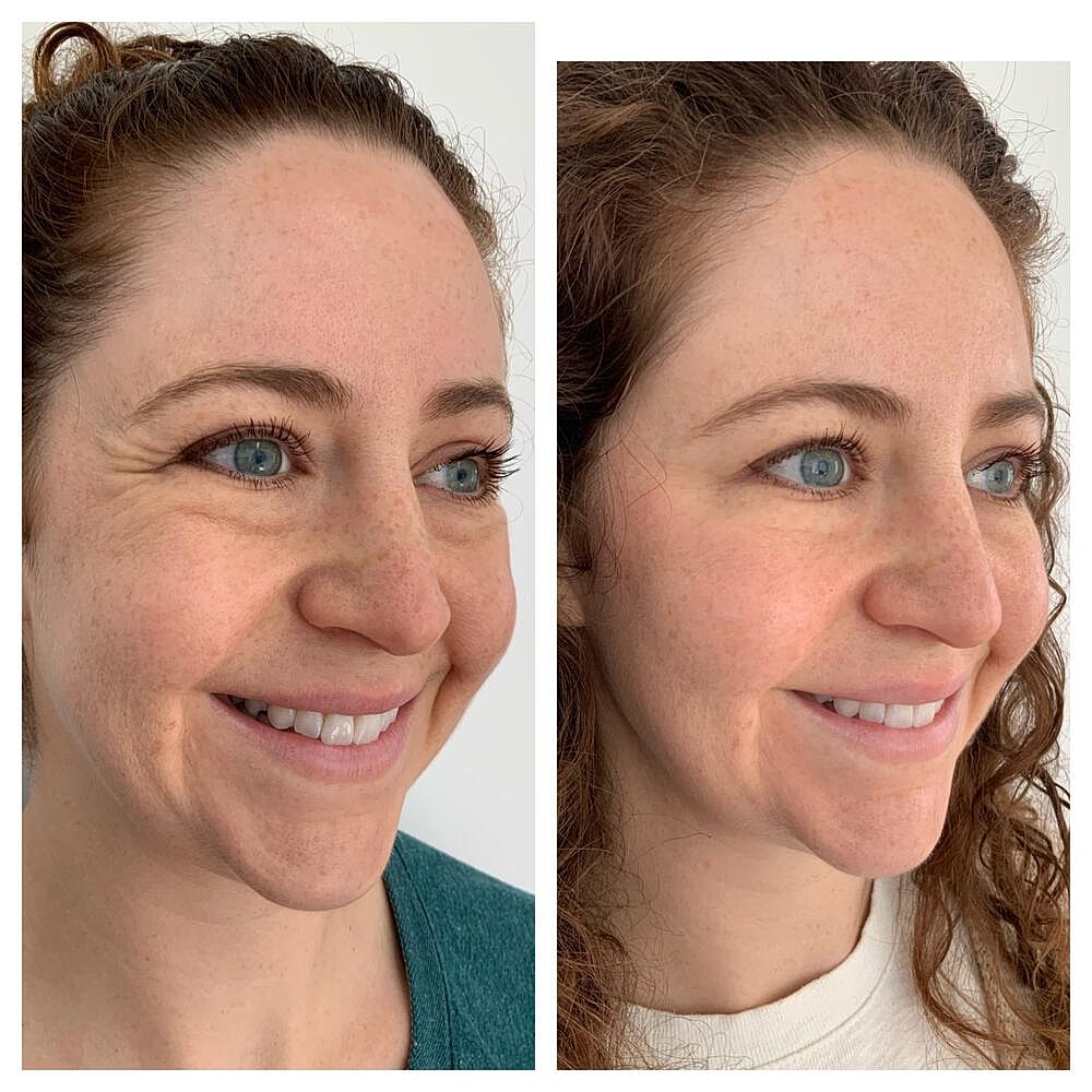Botox Before & After
