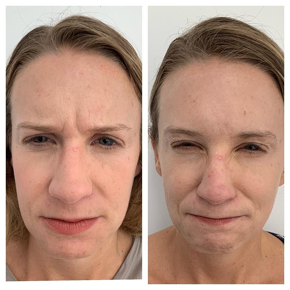 Botox Before & After