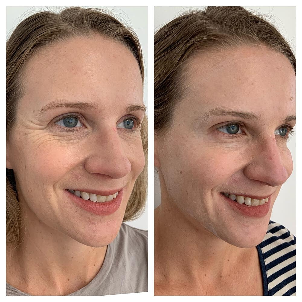 Botox Before & After