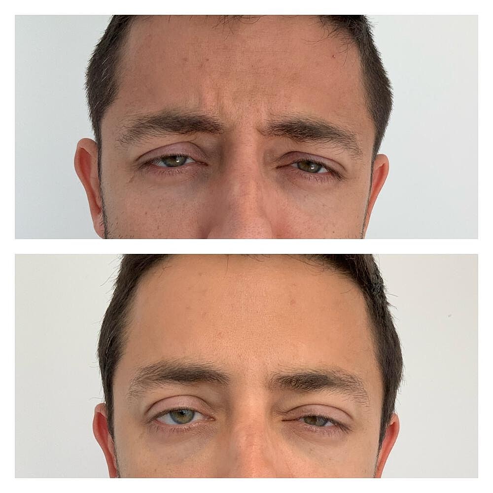Botox Before & After