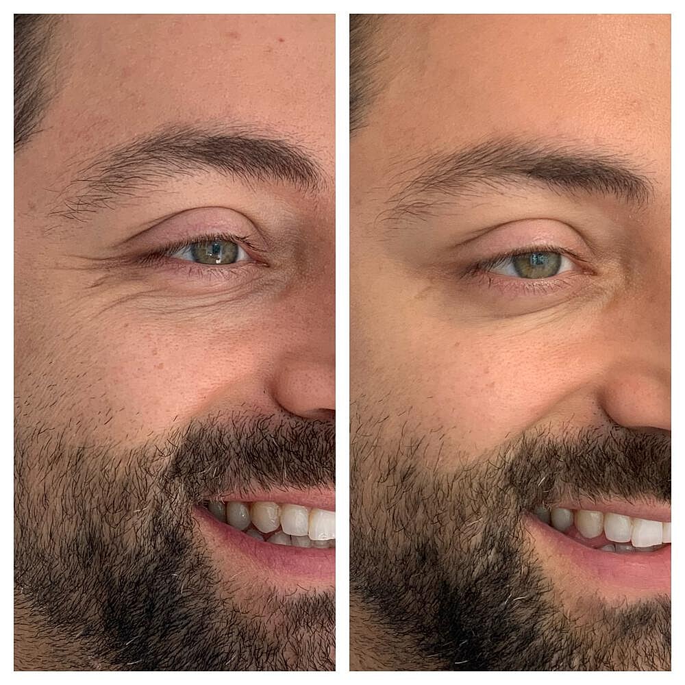 Botox Before & After