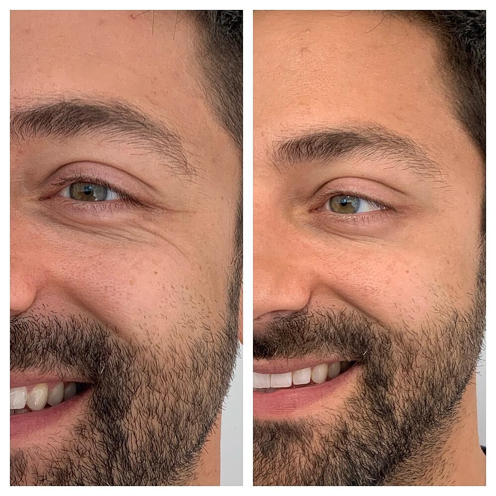 Botox Before & After