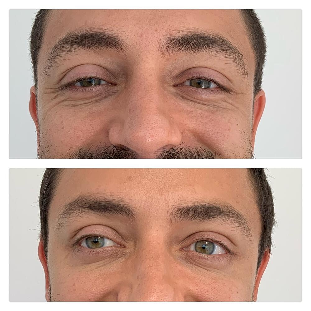 Botox Before & After