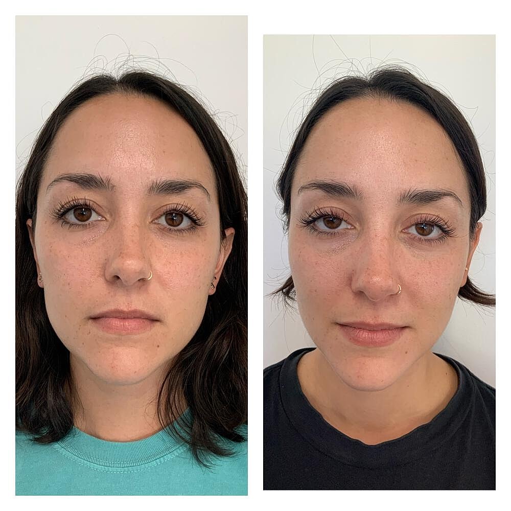 Botox Before & After