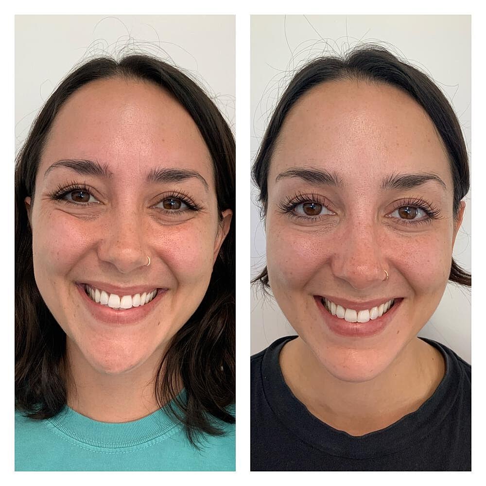 Botox Before & After