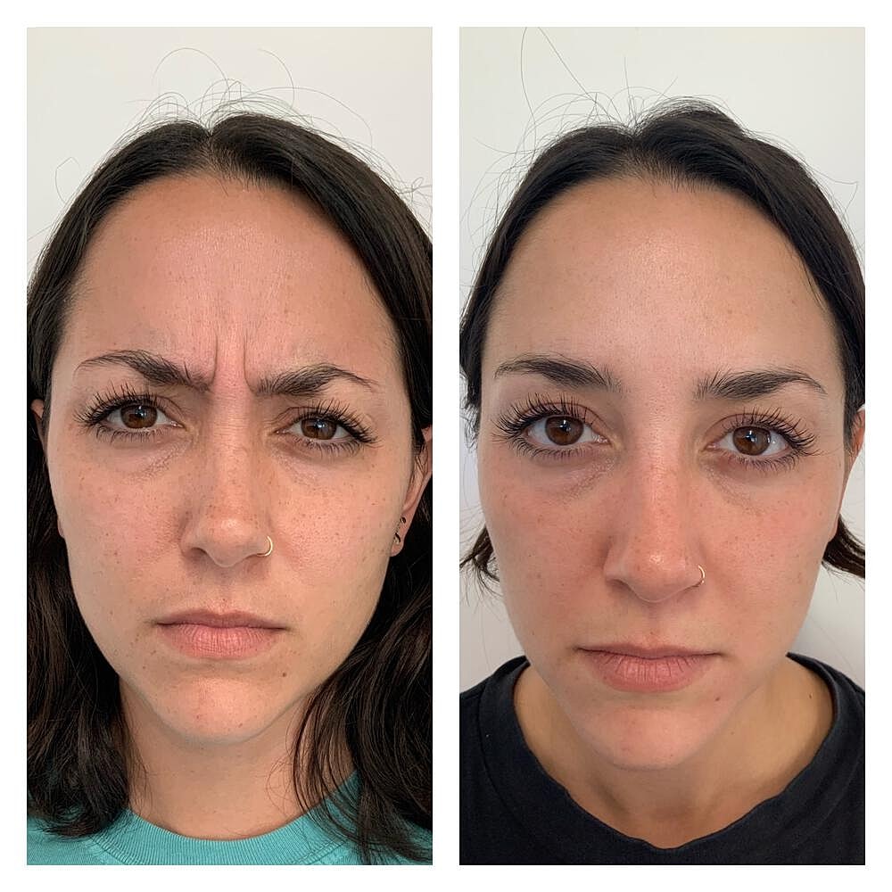 Botox Before & After