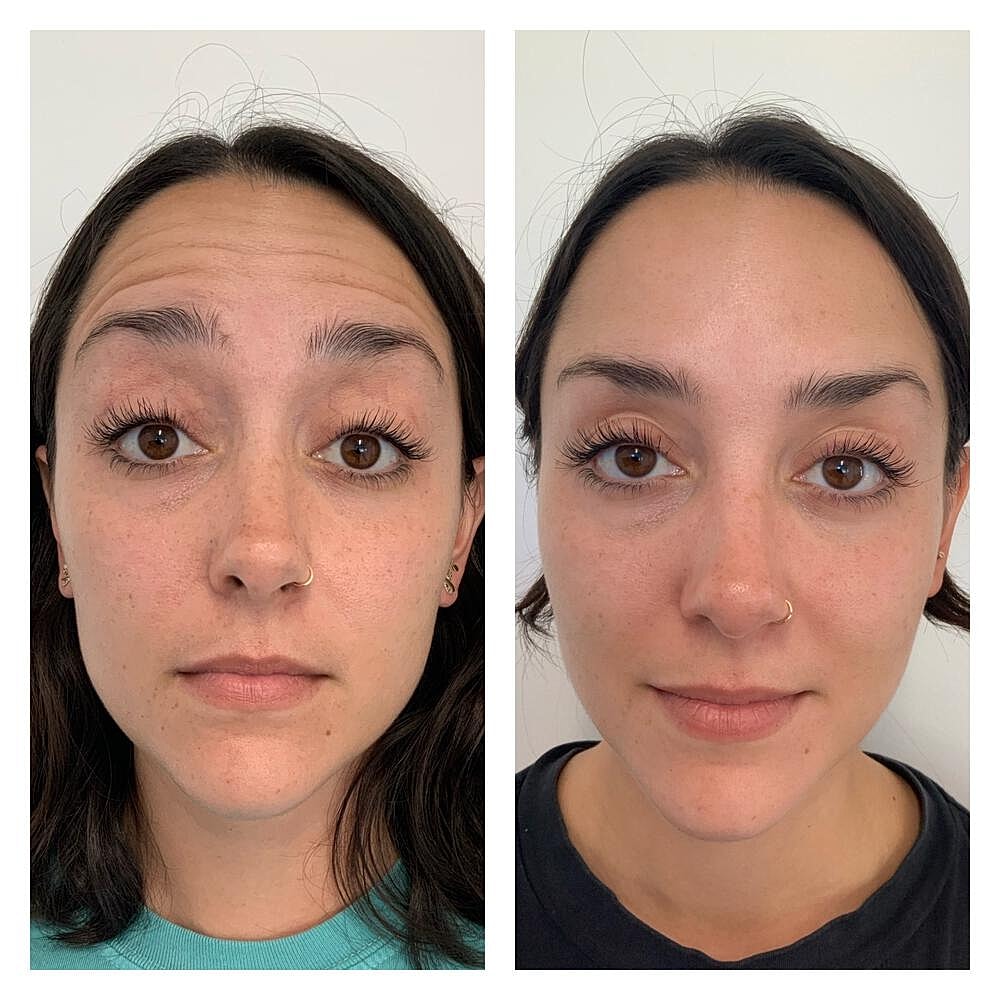 Botox Before & After