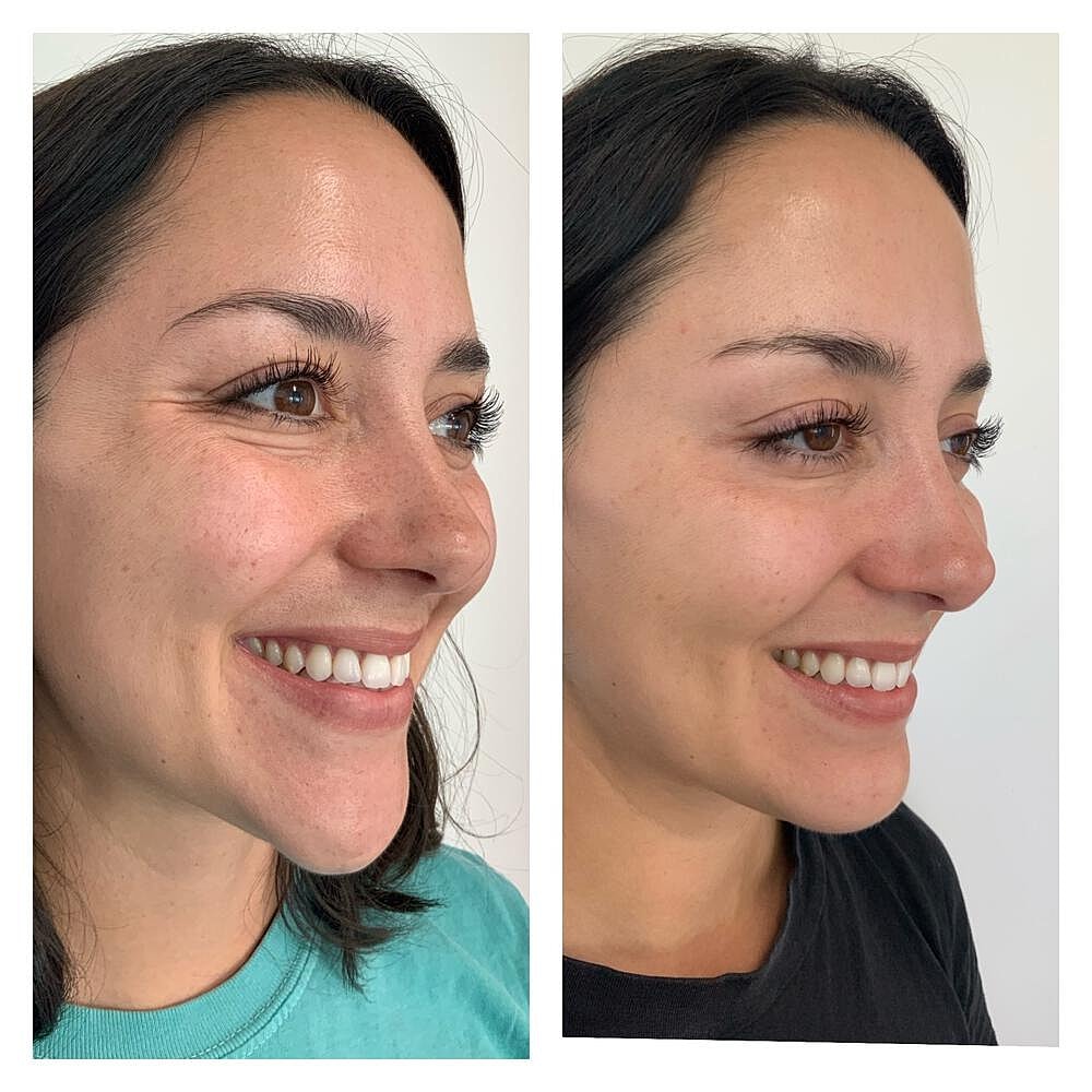 Botox Before & After