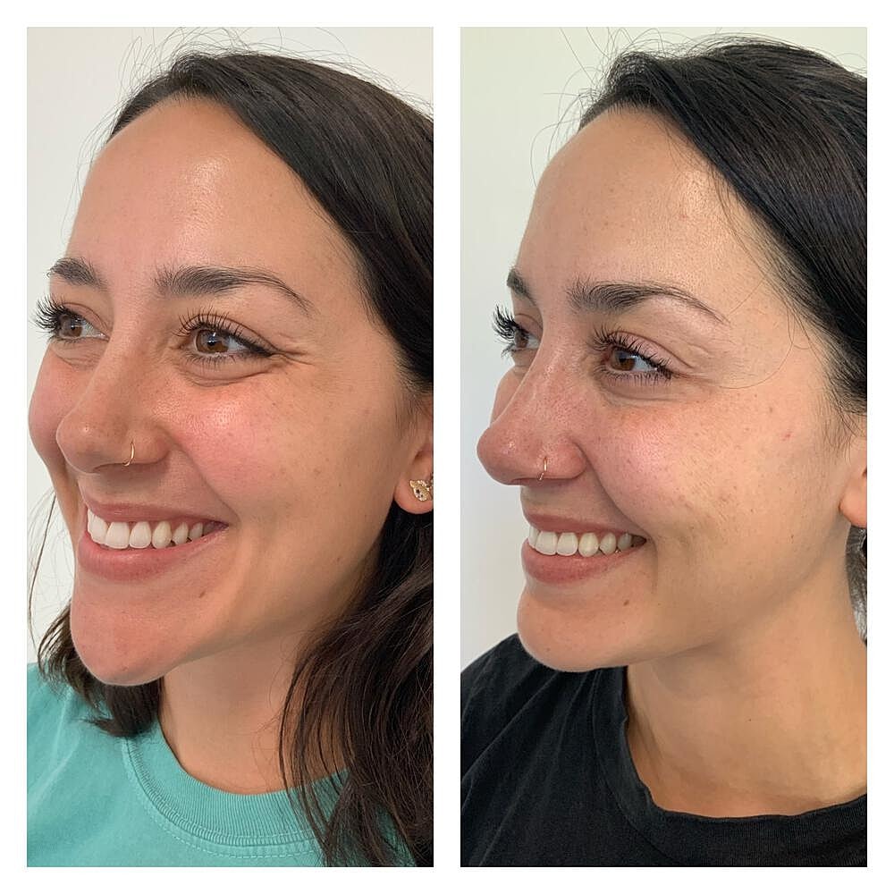 Botox Before & After