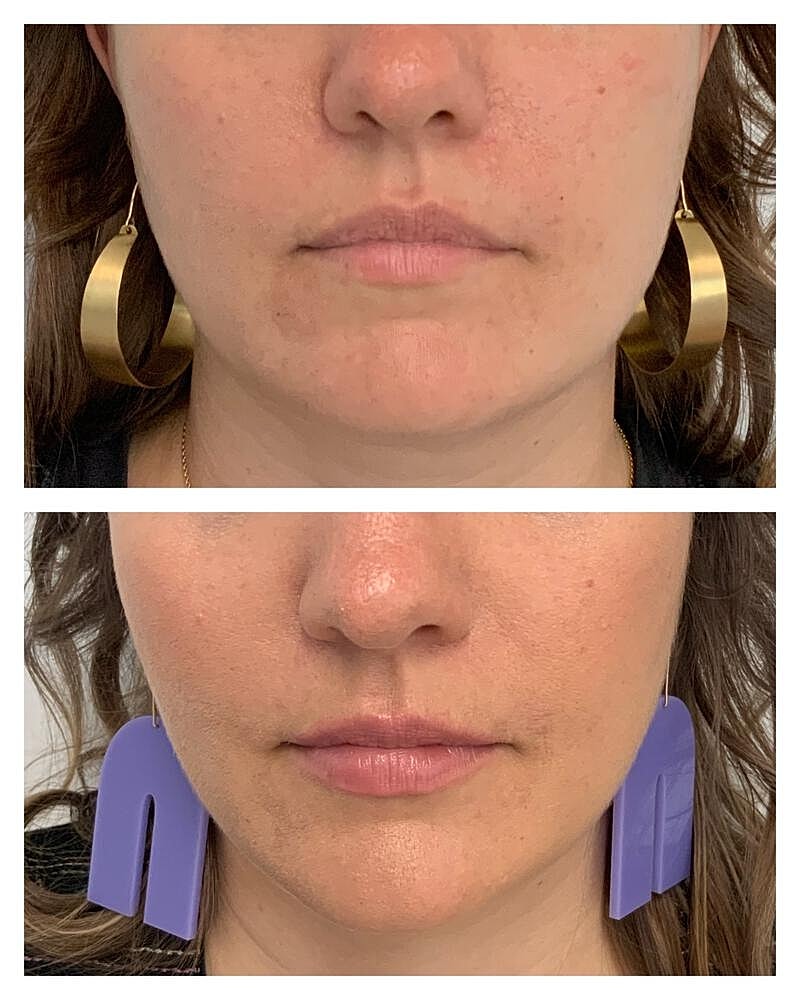 Botox Before & After