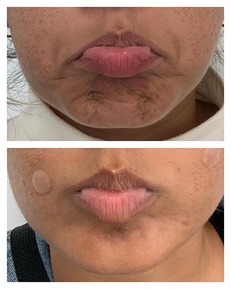 Botox Before & After