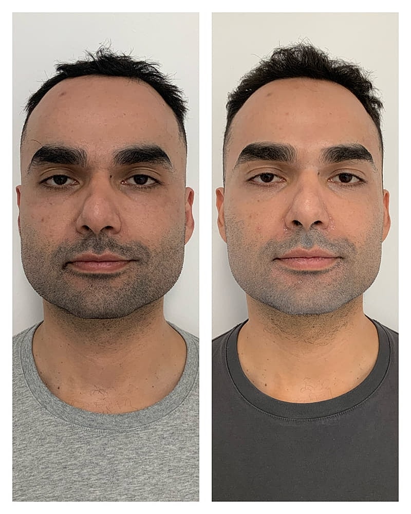 Botox Before & After