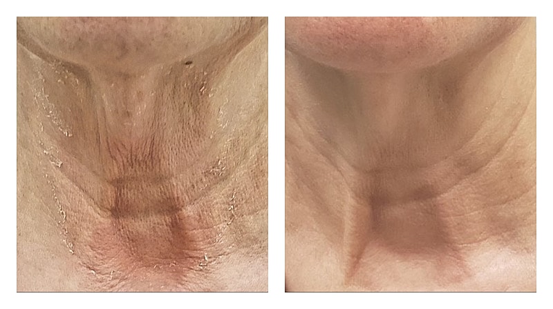 Potenza Rf Microneedling Before & After