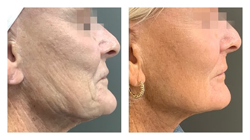 Potenza Rf Microneedling Before & After