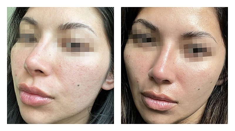 Potenza Rf Microneedling Before & After