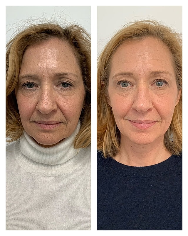 Sculptra Before & After