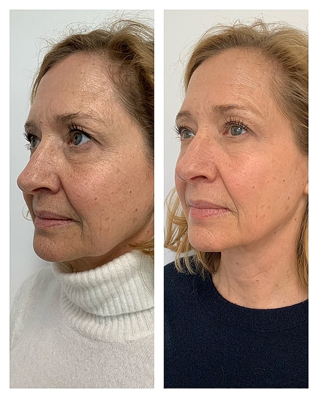 Sculptra Before & After
