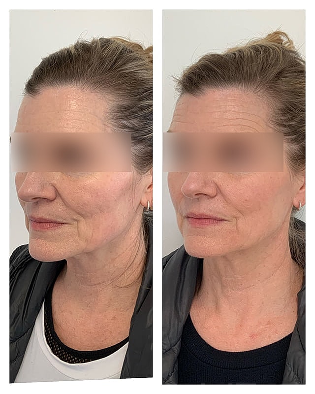 Sculptra Before & After